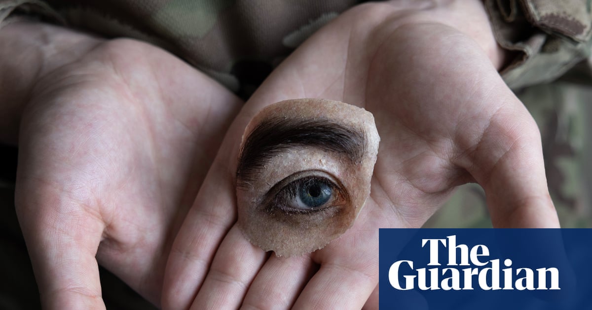 Blinded by War: documenting the aftermath of injury in Ukraine – photo essay